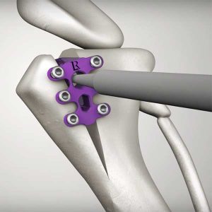 TLC TTA tibial tuberosity advancement